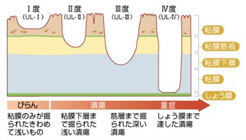 潰瘍とは