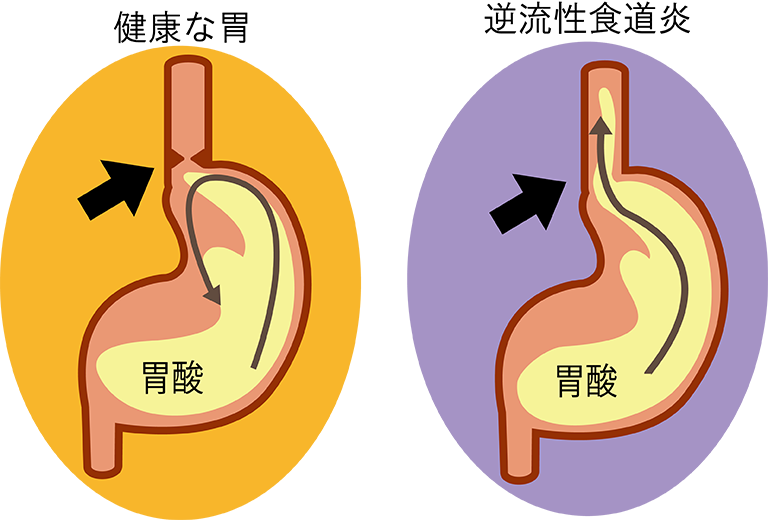 逆流性食道炎とは