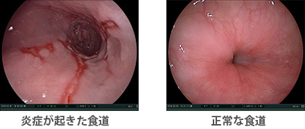 逆流性食道炎の検査・診断