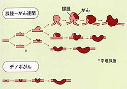 大腸ポリープと大腸がん