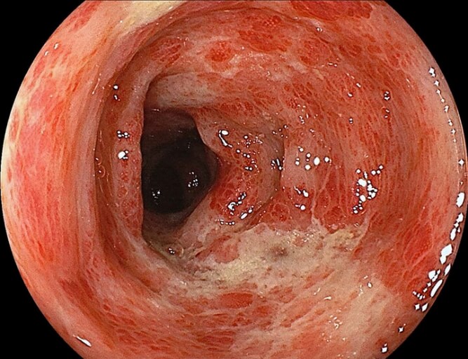 虚血性腸炎の検査・診断