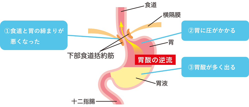 逆流性食道炎の原因