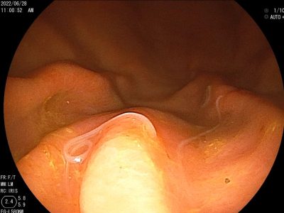 森ノ宮胃腸内視鏡ふじたクリニックで治療した胃のアニサキス