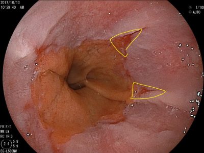 森ノ宮胃腸内視鏡ふじたクリニックの胃カメラで診断がついた逆流性食道炎